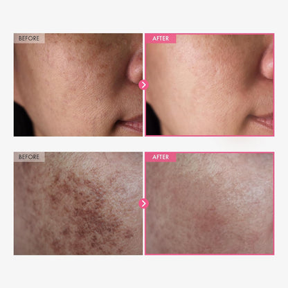 🔥Arbutin 7% + Tranexamic Acid 4% Cream