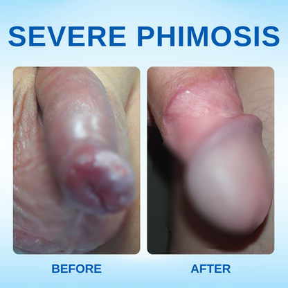 ⚡See Results in Just 24 hours: RZXEA™ Redundant Prepuce Corrector Gel