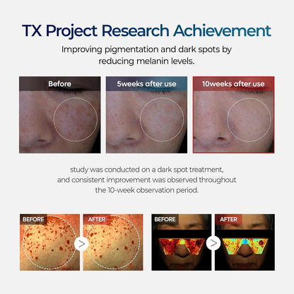 🧪TX Cream Nano-sized Tranexaminc Acid for Dark Spots & Hyperpigmentation