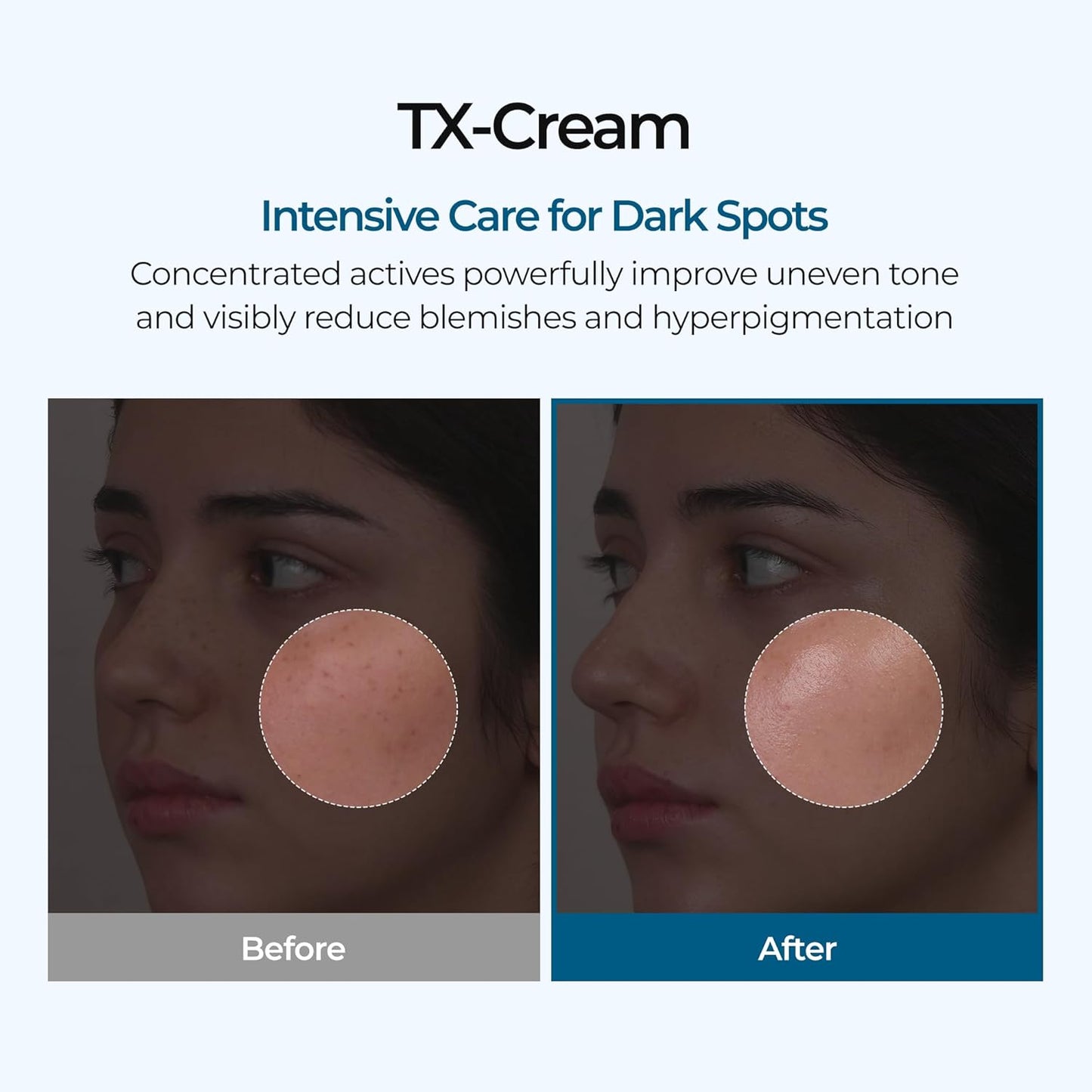 🧪TX Cream Nano-sized Tranexaminc Acid for Dark Spots & Hyperpigmentation