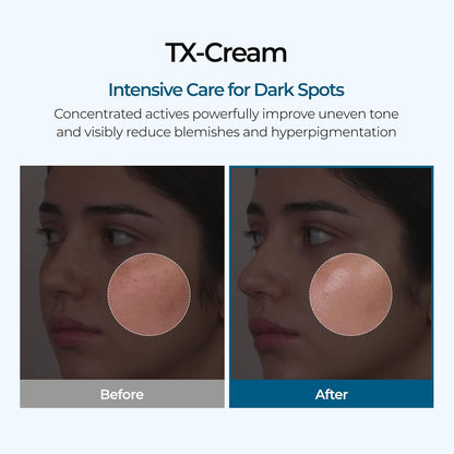 🧪TX Cream Nano-sized Tranexaminc Acid for Dark Spots & Hyperpigmentation